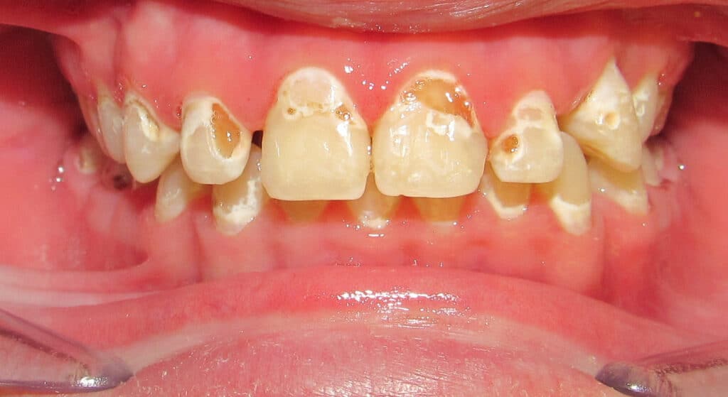 Signs Of Tooth Decay With Braces - Riverside Orthodontics